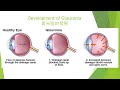 Ophthalmologist Explains Glaucoma 眼科医生解释青光眼