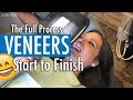 How Do Veneers Work - MY WIFE'S FULL PROCEDURE