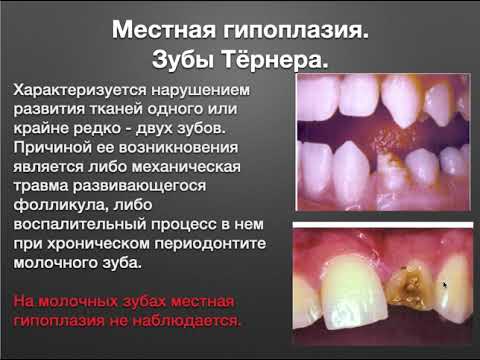 Дифдиагностика ОДЭ, гипоплазии, флюороза