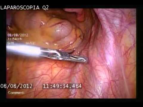 Desinflamar el vientre después de laparoscopia