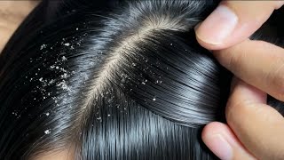 Close Up Kulit Kepala Ini Mengejutkan 😱 | ASMR Ketombe Super Banyak \u0026 Satisfying