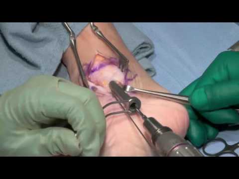 Video: Medial Malleolus Fracture: Behandling, Utvinning Og Mer