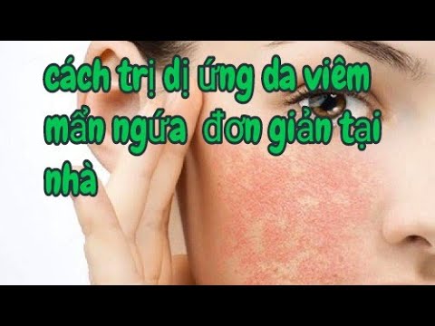 Cách chữa trị dị ứng da, viêm da mẫn ngứa rất hay đơn giản tại nhà @Vinh Vlog Nam Dược