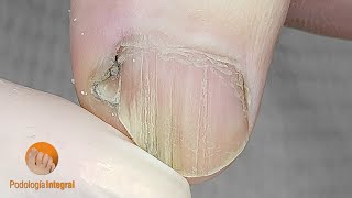 Longitudinal streaks and atrophy at the medial edge of nail plates | Cleaning for immediate welfare