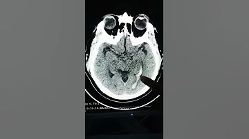 ¿Se puede ver una hemorragia cerebral en una resonancia magnética?