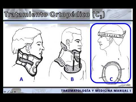 Vídeo: Fractura De Jefferson: Síntomas, Tratamiento, Recuperación Y Más