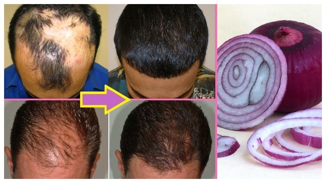 Hair Fall Home Remedy Can onion juice actually prevent hair fall