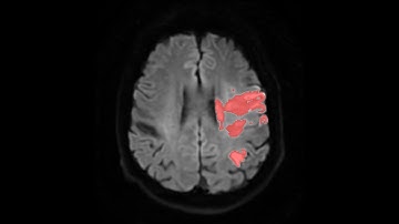 Segmentación del core en difusión con 3D slicer en pacientes con stroke isquémico.