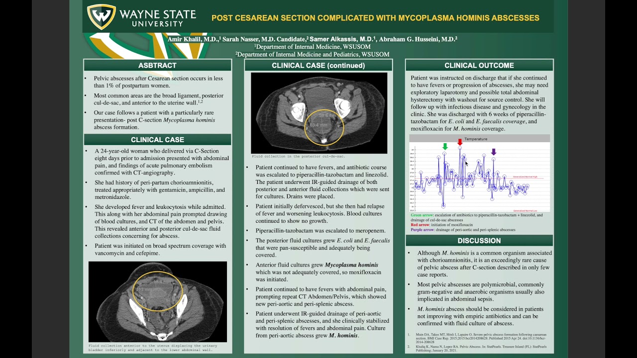 Post C-section complicated by M. Hominis Abscess | ACP MI Residents Day 2021