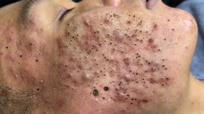 Big Cystic Acne Blackheads Extraction Blackheads & Milia, Whiteheads  Removal Pimple Popping # 1575 - YouTube