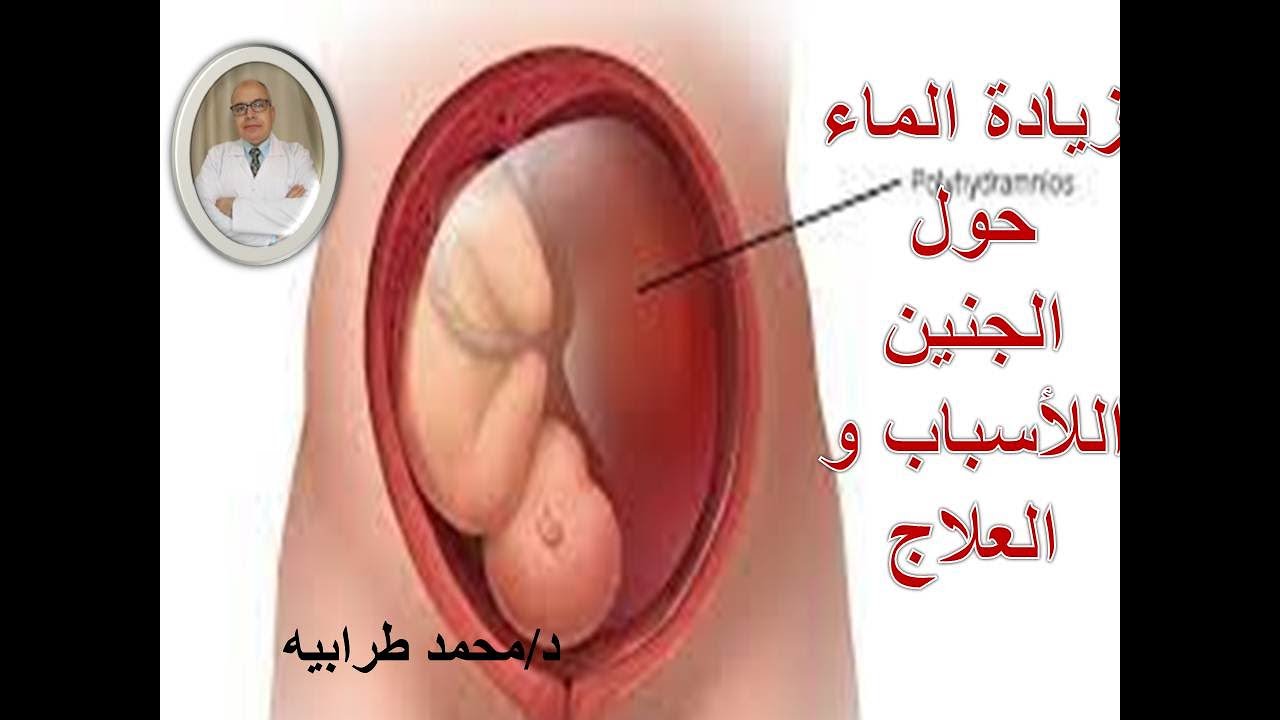 أسباب و علاج زيادة ماء الجنين أو السائل الأمينوسي. #دكتور_محمد_طرابيه