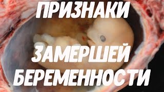 видео Симптомы и признаки внематочной беременности на ранних сроках и поздних