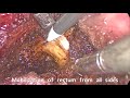 Bleeding at presacral venous plexus during laparoscopic resection of recurrent rectal cancer