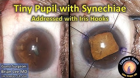 Guest Cataract Surgery: Tiny Pupil with Synechiae addressed with Iris Hooks