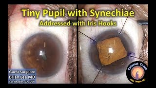 Guest Cataract Surgery: Tiny Pupil with Synechiae addressed with Iris Hooks