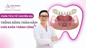 Trồng răng Implant toàn hàm là gì? | Cùng chuyên gia giải mã trồng răng Implant toàn hàm