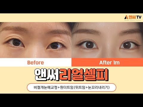 자연유착 + 비절개눈매교정 + 원더트임 1개월까지 리얼후기! l 앤써성형외과 Answer Plastic Surgery
