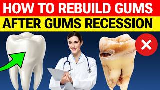 How to Rebuild Gums? #1 Secret Reverses Cavities Naturally