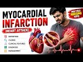 MYOCARDIAL INFRACTION PART -2