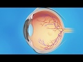 Edema macular cistoide: inyecciones de medicamentos