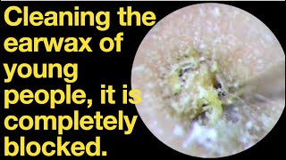 Cleaning the earwax of young people, it is completely blocked.|ear wax removal | ear cleaning | ASMR