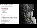 Cauda Equina Syndrome | Presentation, Risk Factors, & Signs/Symptoms