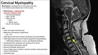 Cauda Equina Syndrome | Presentation, Risk Factors, & Signs/Symptoms