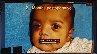 AIOC 2026 - IC205 - Dr.Mandal A.K. Axenfeld-rieger Syndrome: a Diverse Clinical Spectrum