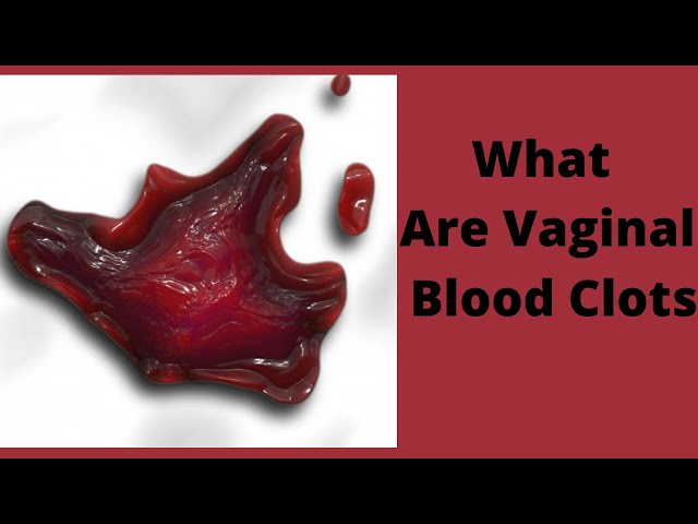 What Are Vaginal Blood Clots 