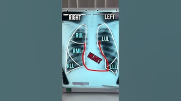 BEST WAY TO READ CHEST X-RAY