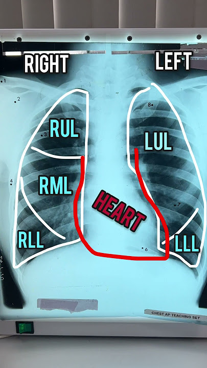 BEST WAY TO READ CHEST X-RAY