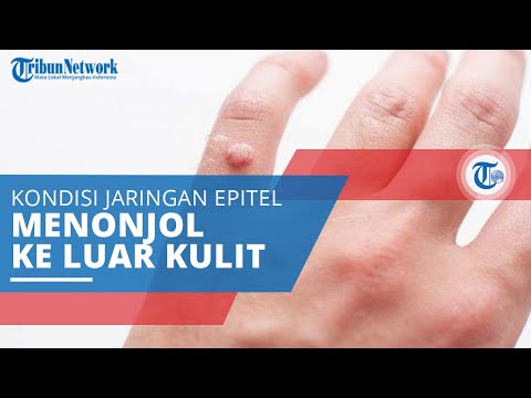 Papiloma, Benjolan yang Terbentuk dari Jaringan Epitel yang Menonjol ke Luar