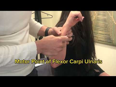 Electroacupuncture Flexor Carpi Ulnaris Motor Point