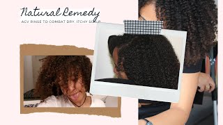 NATURAL REMEDY! ACV rinse to combat DRY and ITCHY scalp |shazachieng