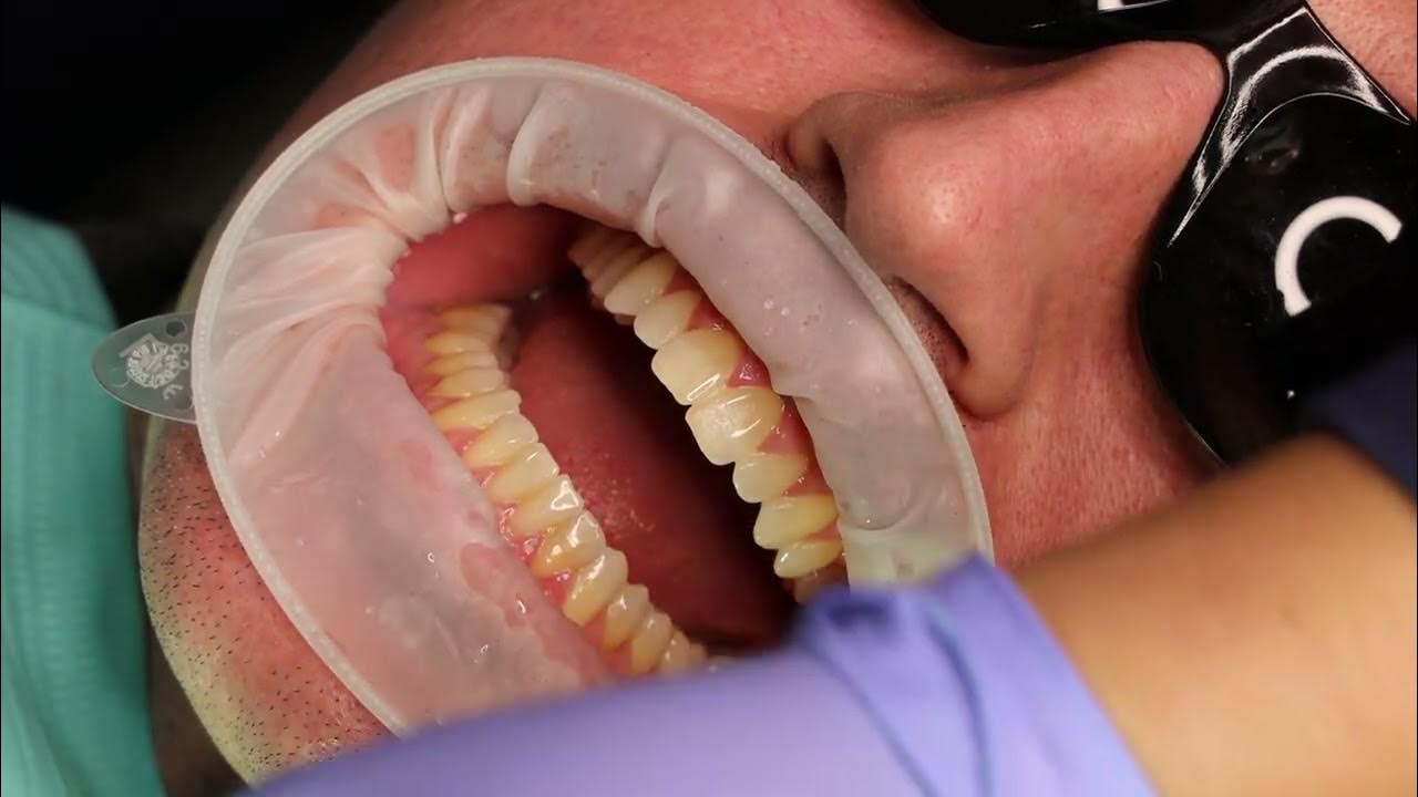 Isolation Optragate, Dryshield, Cotton Roll YouTube