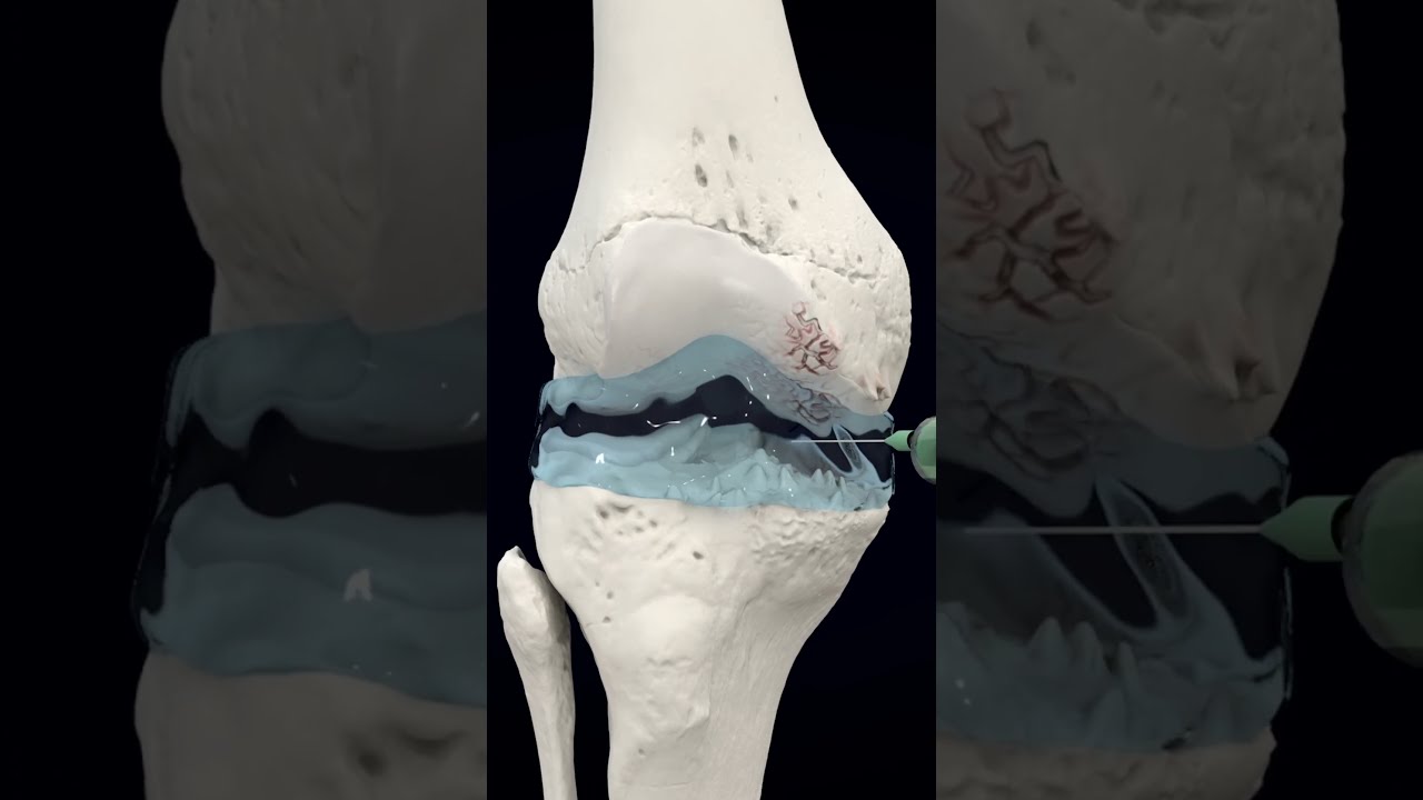Visco Gel Injections For Knee Arthritis Pain