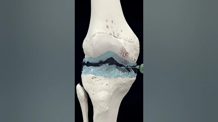 Visco-gel injections for knee arthritis pain - DayDayNews