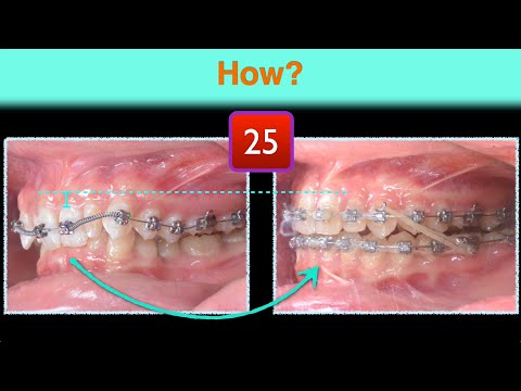 Class II with Deep Bite |【Chris Chang Ortho】CC862 - YouTube