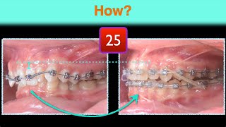 Class II with Deep Bite  |【Chris Chang Ortho】CC862