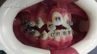 تقويم الأسنان وشكلها المذهل  بعد ثلاثة أشهر من بدايته