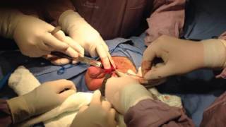 Dorsal profunda agrandada vena