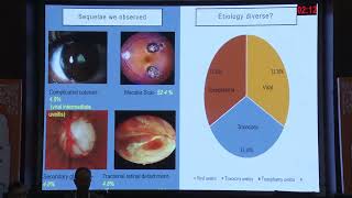 Information AIOC2026   FP1452   T Dr Bhavya Annadevula Paediatric infectious uveitis  lessons learnt News