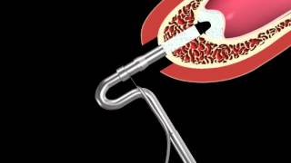 Neobiotech Sca - Bone Carrier