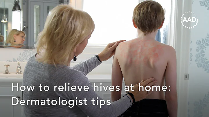 How to relieve hives at home - DayDayNews