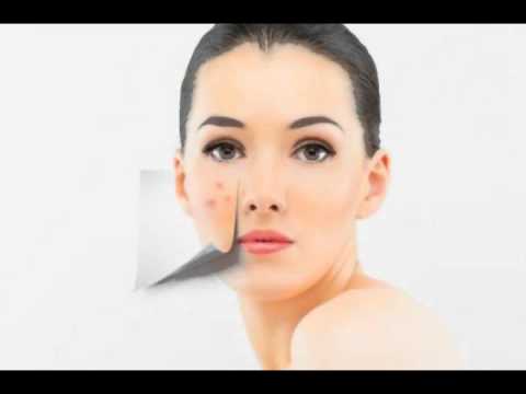 Adult Acne NYC - Dr. Ostad Discusses The Cause & Prevention Of Adult Acne