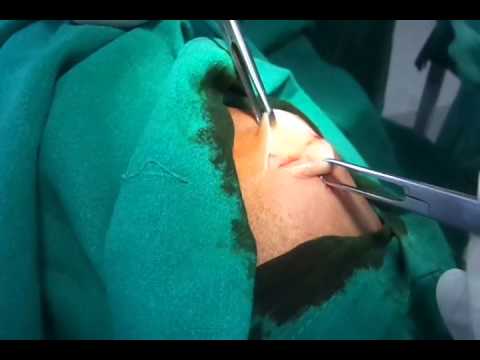 Removal of Lipoma (A Fat swelling) lump sugar