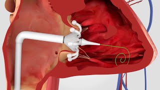 Minimally Invasive Procedures for Structural Heart Disease
