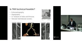 Selecting TAVI Patients - Prof Darren Walters