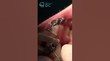 22 Tháng Biến Đổi: Hành Trình Niềng Răng Và Kết Quả Viên Mãn | Dr Cường Official