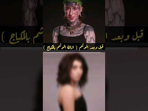 شاهد قبل وبعد ازالة الوشم ازالة الوشم بالمكياج لا إله إلا الله عدد خلقه ومداد كلماته